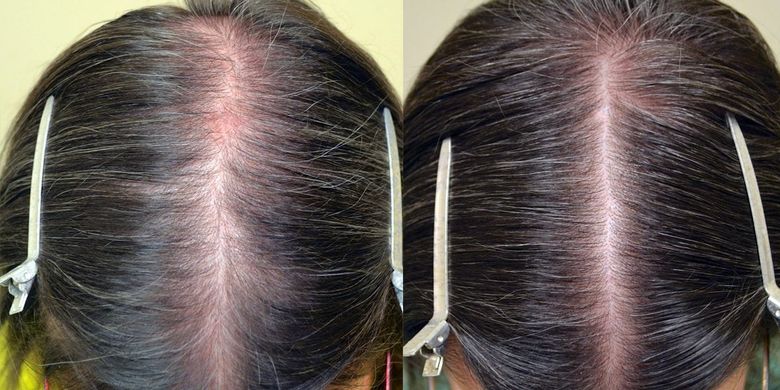 Лосьон для роста волос Minox 2, (200 мл, хватает на 4 месяца)