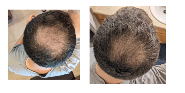 Лосьон-спрей для роста волос Minox 5% (200мл, хватает на 4 месяца)