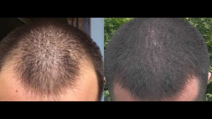 Лосьон для роста бороды Minox 7% (200мл, хватает на 4 месяца)